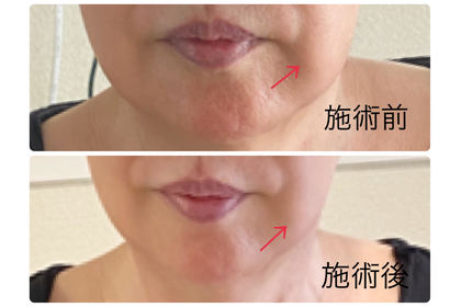 頬結節
