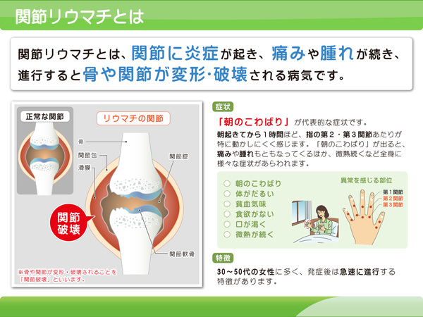 関節リウマチと当院の施術について 横浜で評判の整体院 横浜visseマッサージ治療院のブログ