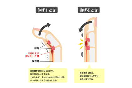 バネ指