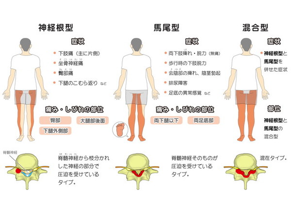 脊柱管狭窄症
