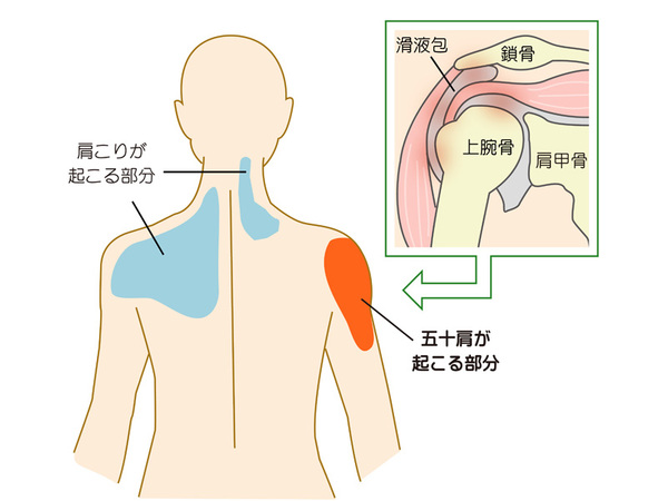 五十肩
